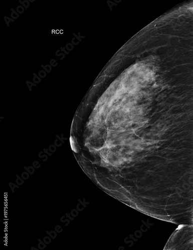 Bilateral craniocaudal (CC) view  mammogram of healthy breasts showing benign tissue (BI-RADS 2).