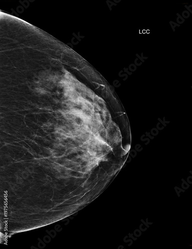 Bilateral craniocaudal (CC) view  mammogram of healthy breasts showing benign tissue (BI-RADS 2).