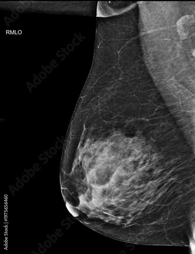 Bilateral mediolateral oblique (MLO) mammogram of healthy breasts showing benign tissue (BI-RADS 2) .