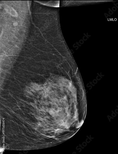 Bilateral mediolateral oblique (MLO) mammogram of healthy breasts showing benign tissue (BI-RADS 2) .