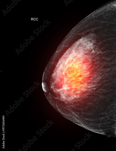 Right craniocaudal (RCC) mammogram featuring a glowing red area to represent breast cancer.