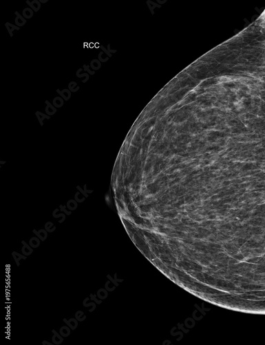 Right craniocaudal (RCC) mammogram scan revealing benign calcifications and cysts (BI-RADS 2). Ideal for breast cancer awareness and women's health screening concepts.
