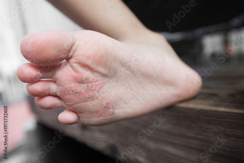 The skin on the child's feet is sore and itchy.
