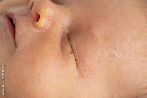 Close-up of a newborn's eye showing lacrimal duct immaturity and early signs of dacryocystitis, with mild tearing around the eye.