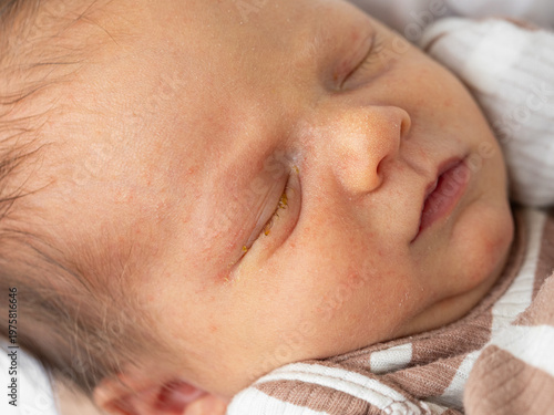 Wallpaper Mural Close-up of a newborn's eye showing lacrimal duct immaturity and early signs of dacryocystitis, with mild tearing around the eye. Torontodigital.ca