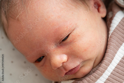 Wallpaper Mural Close-up of a newborn baby’s face showing mild neonatal acne with small red pimples on the cheeks and forehead, soft skin, and a calm expression. Torontodigital.ca