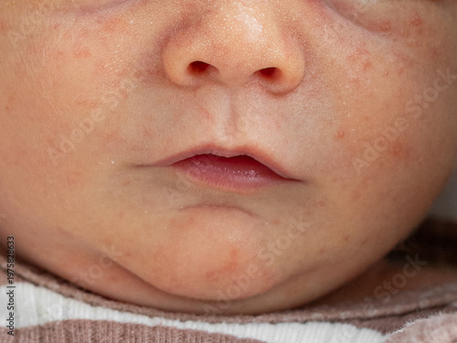 Wallpaper Mural Close-up of a newborn baby’s face showing mild neonatal acne with small red pimples on the cheeks and forehead, soft skin, and a calm expression. Torontodigital.ca