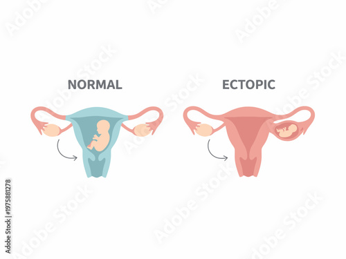 Normal and Ectopic Pregnancy Comparison Medical Illustration