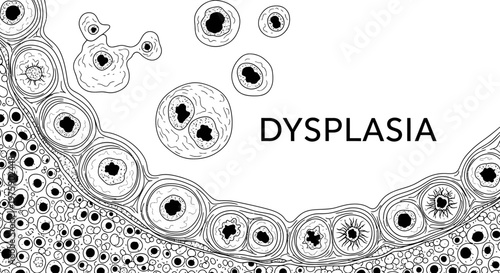 Medical Illustration of Dysplasia Cells in Black and White Line Art.