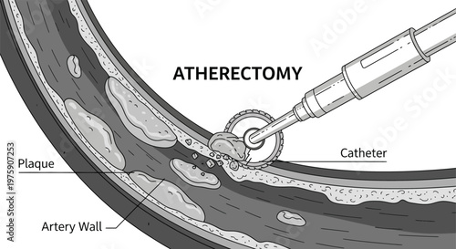 Atherectomy medical procedure illustration showing plaque removal from artery wall using a catheter.