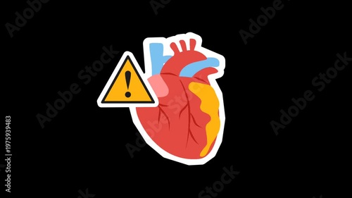 Coronary artery disease medical illustration. Heart blockage and atherosclerosis animation