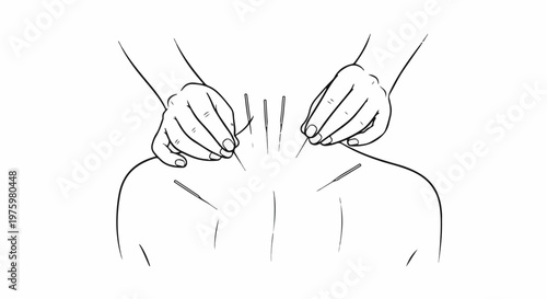 Hands carefully applying acupuncture needles to a person's back