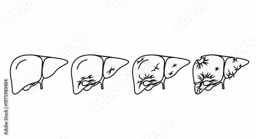 Four stages of liver damage shown in a medical illustration