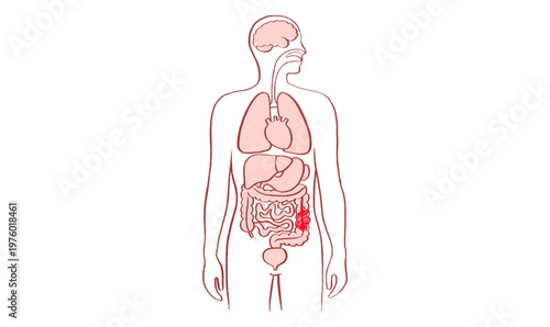 Intestine diseases sketch