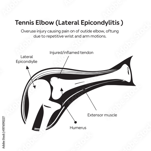 Tennis elbow illustration depicting lateral epicondylitis and tendon inflammation