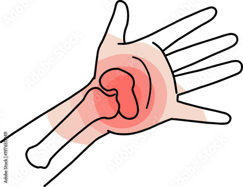 Hand injury illustration featuring a hand with highlighted pain area and bone structure drawing on a transparent background for medical or educational purposes.