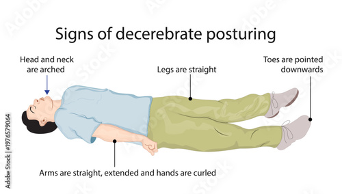 Signs of decerebrate posturing
Abnormal extension posture with rigid arms, extended legs, plantar flexion, and pronated forearms indicating severe brainstem dysfunction.