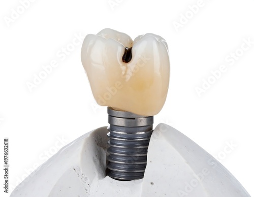 Close-up of a dental implant with a porcelain crown, isolated on white