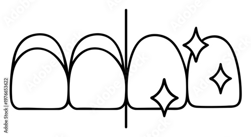 Gum contouring and gingivectomy procedure, correction of gummy smile with extended tooth crown appearance