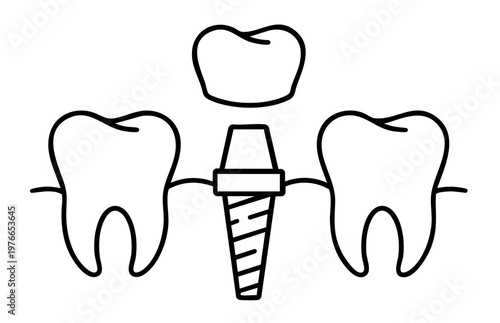 Dental implant with screw root and crown replacement, artificial tooth restoration after tooth loss