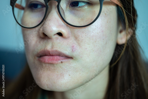 Cropped shot view of acne occur on Asian woman face. Allergies, irritants, genetic makeup, etc can cause skin conditions.