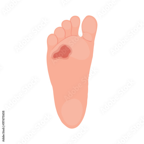 Diabetic Foot Ulcer Stages Medical Illustration