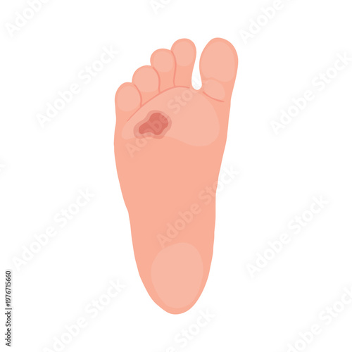 Diabetic Foot Ulcer Stages Medical Illustration