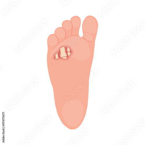 Diabetic Foot Ulcer Stages Medical Illustration