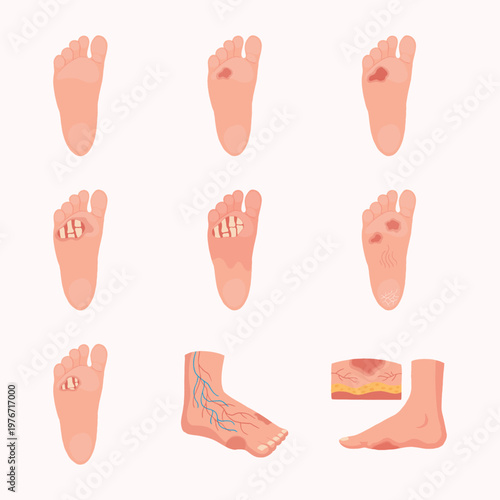 Diabetic Foot Ulcer Stages Medical Illustration