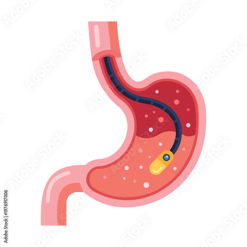 Medical Illustration of Endoscopic Procedure: An insightful medical illustration showcases a detailed view of the human stomach during an endoscopic procedure.