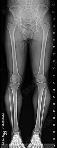 Full-Length Lower Limb X-ray Scanogram for Alignment and Leg Length Study.