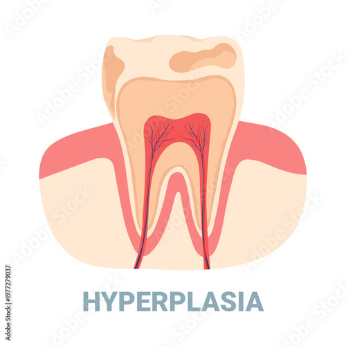 Detailed isolated diagram showing tooth hyperplasia and dental pulp anatomy for medical education vector illustration