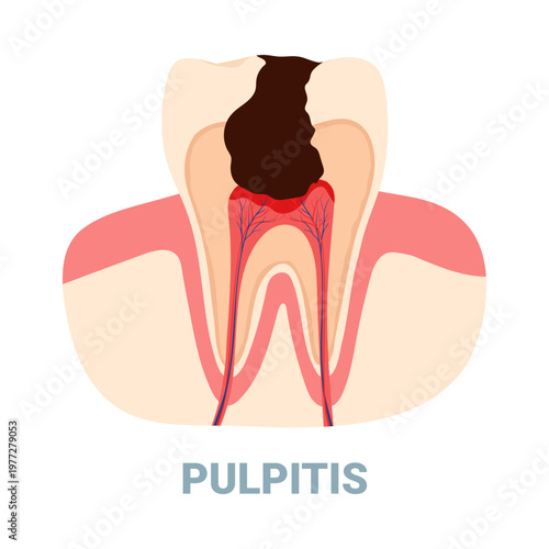 Detailed isolated diagram showing pulpitis dental problem with inflamed tooth nerve and cavity vector illustration