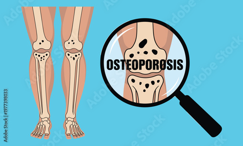 Of osteoporosis in femur bones with magnifying glass and text