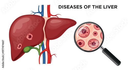 Medical illustration showing a human liver with visible diseased areas and a magnifying glass providing a closer look at damaged cells.