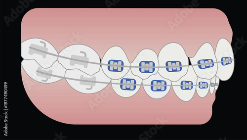 Teeth with Braces and Archwire