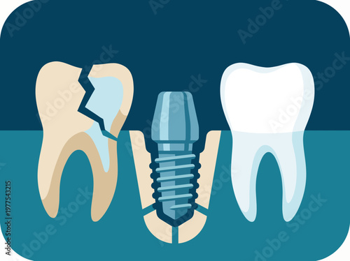 This image features a dental implant between a broken tooth and a healthy tooth, symbolizing the importance of dental care and restoration options in oral health.