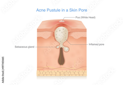 Acne pustule inside a skin pore showing a clogged pore filled with pus (whitehead), caused by excess sebum and bacteria. Inflamed pore and sebaceous gland in a cross section skin diagram.  Medical ill