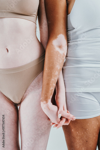 Group of multiethnic women with different kind of skin posing together in studio. Concept about body positivity and self acceptance