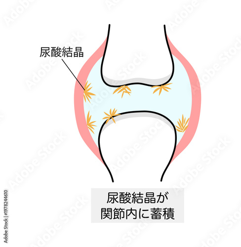 痛風における尿酸結晶が沈着した関節のイラスト