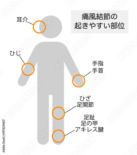 痛風結節が起きやすい部位を説明したイラスト