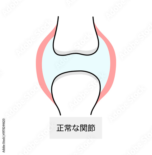 痛風における正常な関節のイラスト