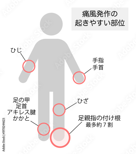 痛風発作が起きやすい部位を説明したイラスト