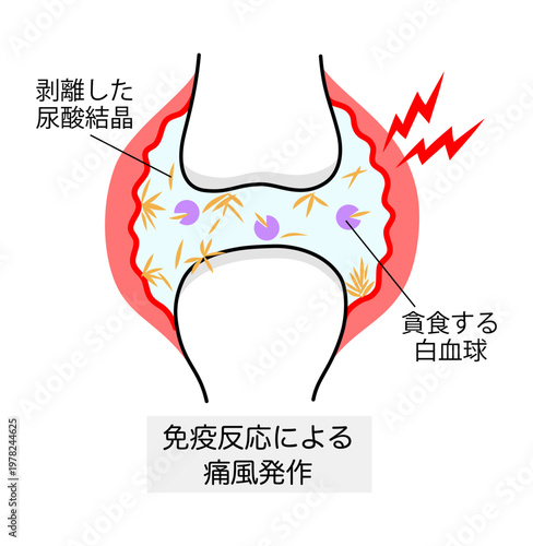 痛風発作を起こした関節のイラスト