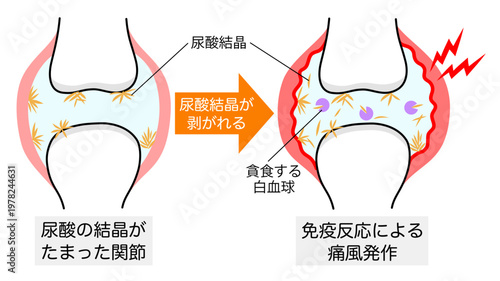 尿酸結晶が剥がれて痛風発作が起きた関節の比較イラスト