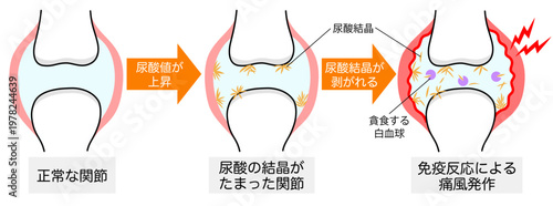 正常な関節・尿酸結晶ができた関節・痛風発作が起きた関節の比較イラスト