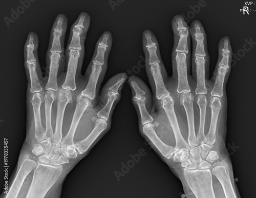 Anterior-Posterior Hand X-ray Showing Osteoarthritis with Joint Space Narrowing and Osteophytes.