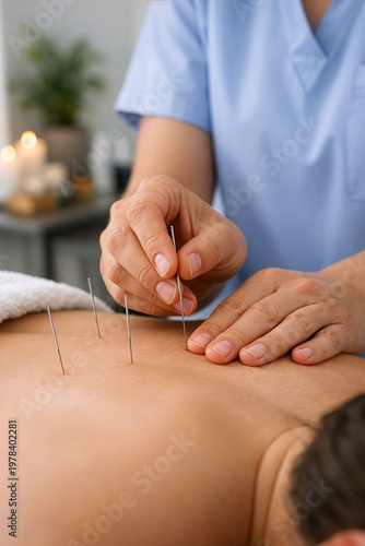 Close‑up scene of a healthcare professional performing acupuncture on a patient’s. Thin needles are inserted with precision in a calm clinical setting, highlighting traditional medical practice.