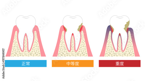歯周ポケット　虫歯