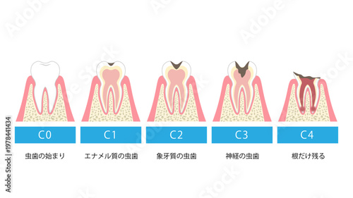 虫歯の流れ　進行